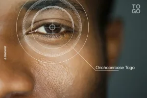 Togo : Vers l’éradication définitive de l’onchocercose